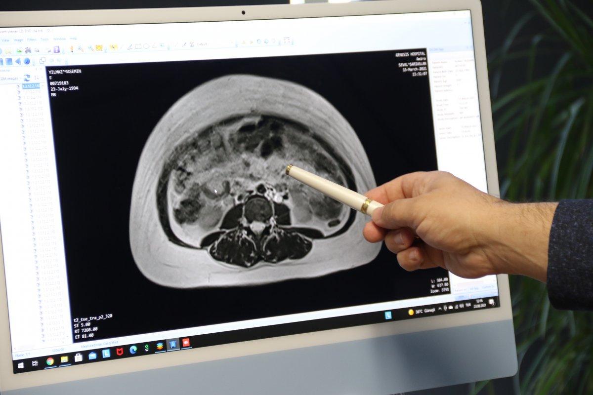 Şişkinlik yaşayan kadının karnında kist tespit edildi