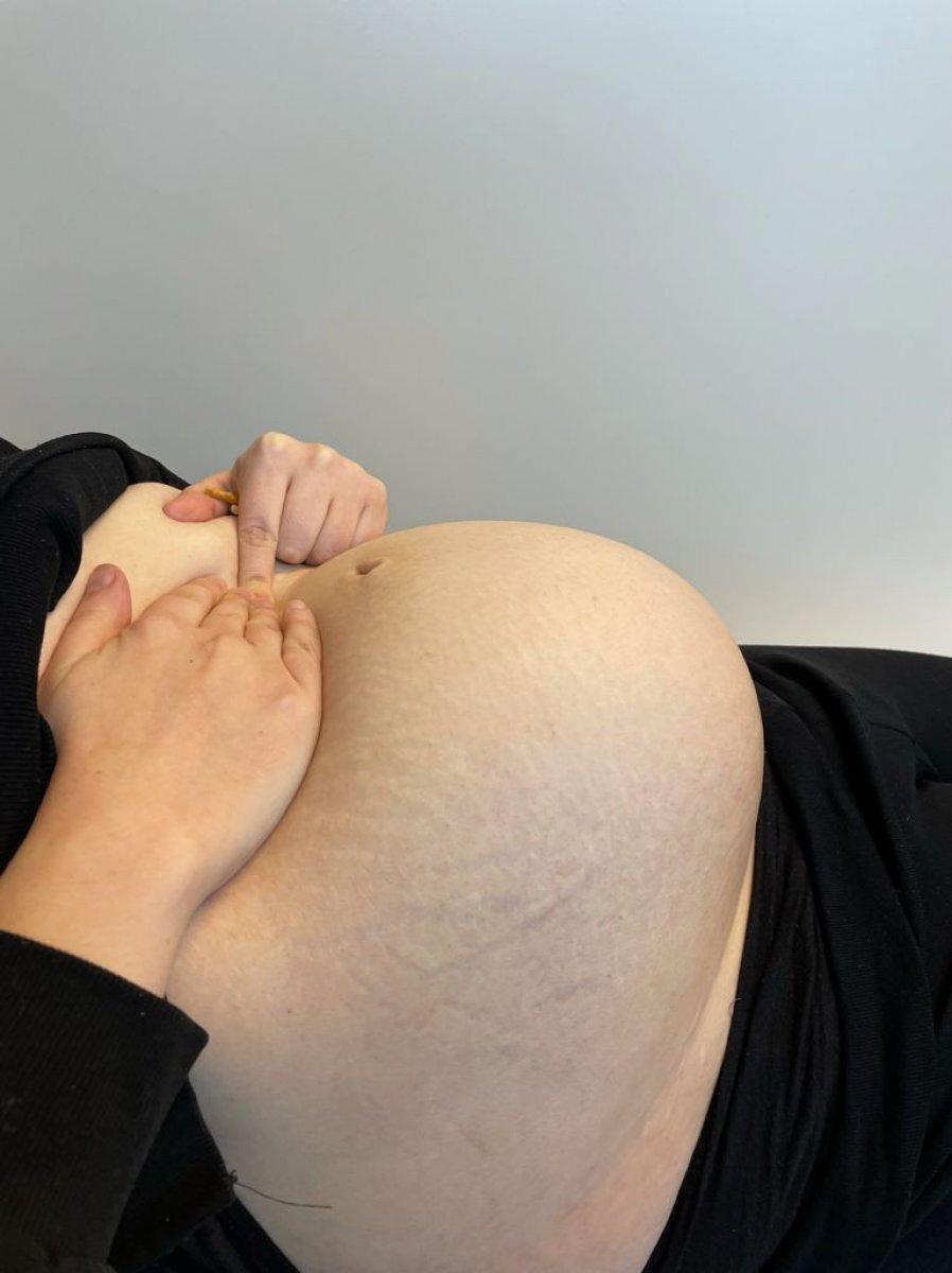 Şişkinlik yaşayan kadının karnında kist tespit edildi