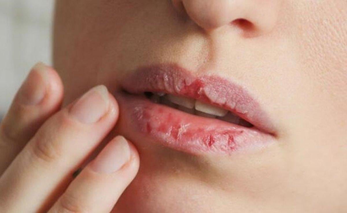 Dudaklardaki renk değişiklikleri hastalık habercisi olabilir