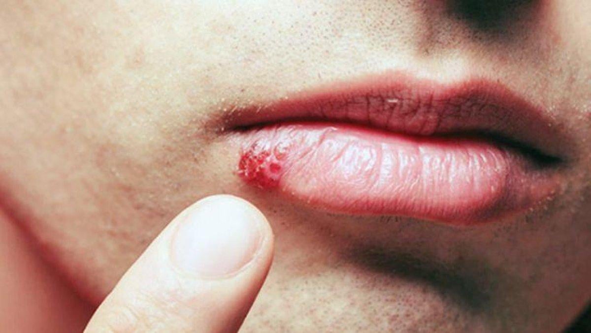 Dudaklardaki renk değişiklikleri hastalık habercisi olabilir