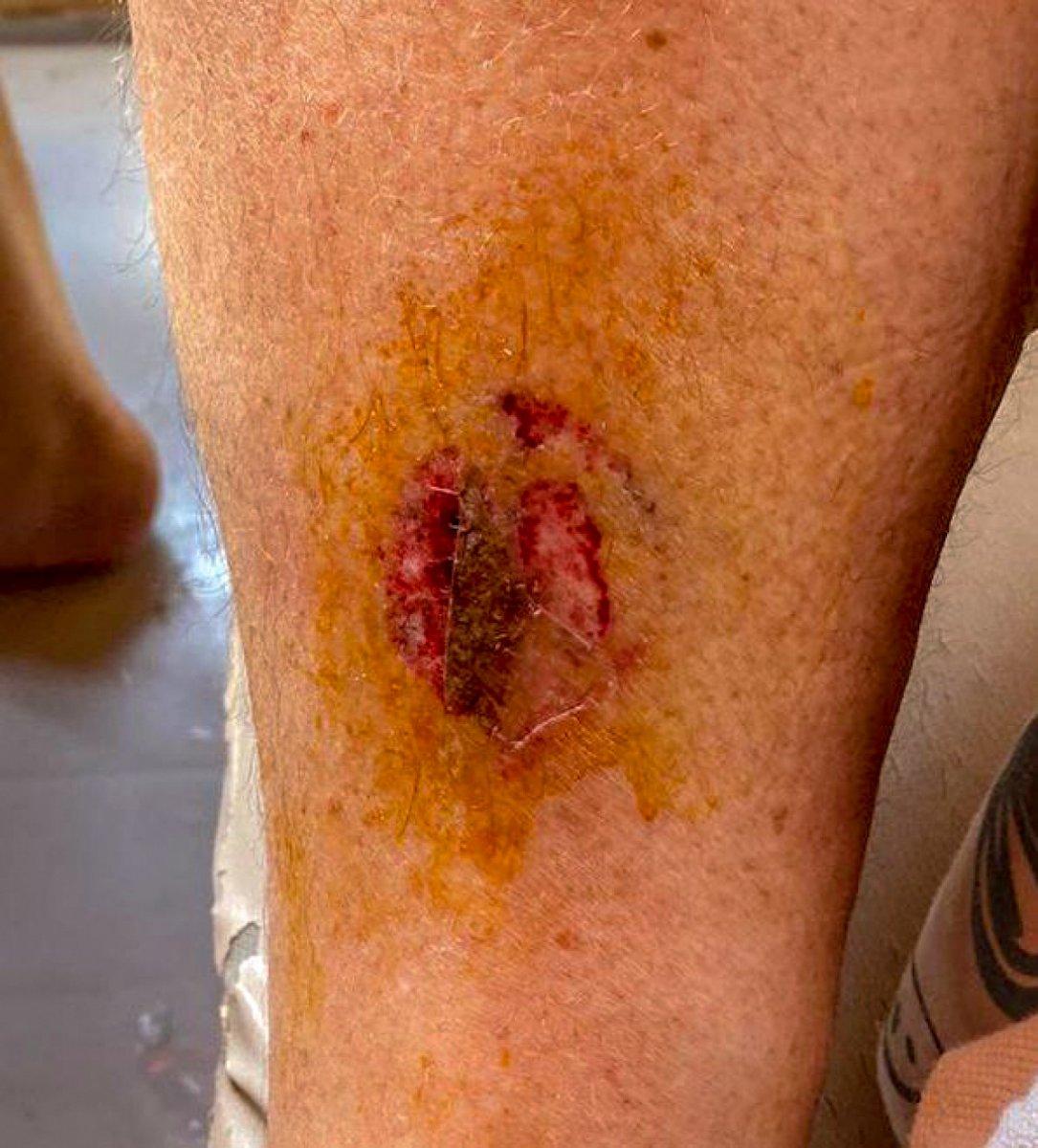 Muğla’da denize giren kadını caretta caretta ısırdı