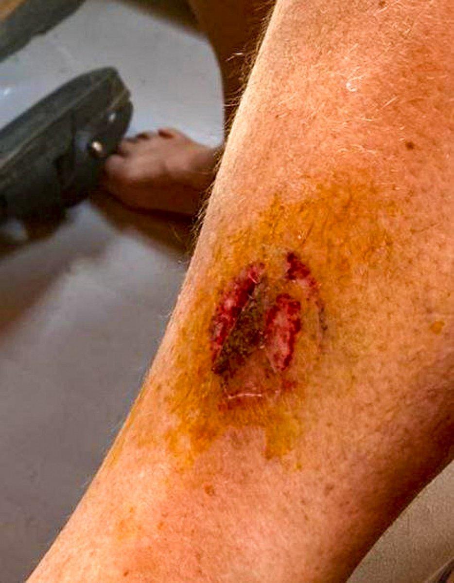 Muğla’da denize giren kadını caretta caretta ısırdı