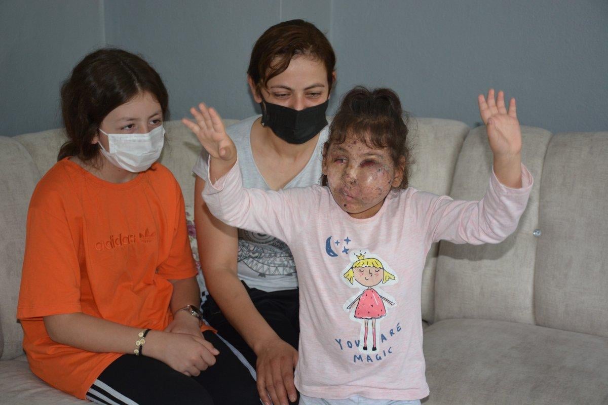 Karabük'te Mikrosefali hastası Sahra, yardım bekliyor