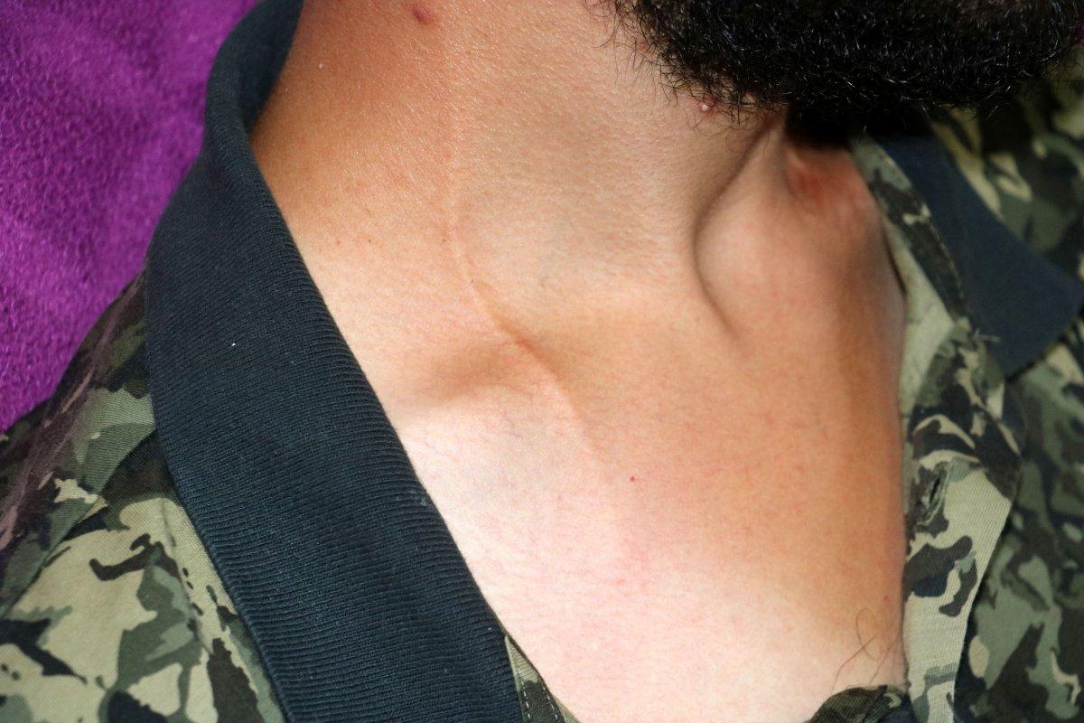 İstanbul'da iş kazası geçiren genç, yıllardır güneşe hasret