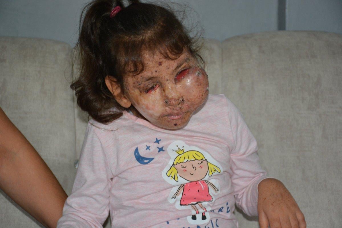 Karabük'te Mikrosefali hastası Sahra, yardım bekliyor