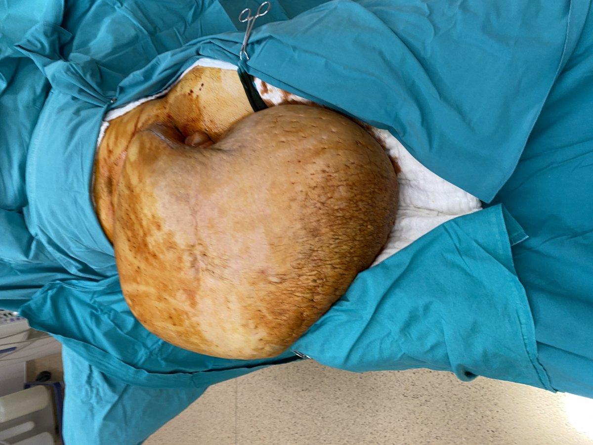 Ispartalı Hakan’ın bedeninden tam 35 kiloluk kitle çıktı