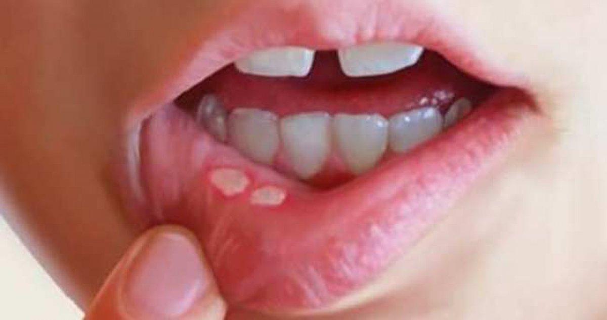 Ağız yaralarını hafifletmek için 5 doğal çözüm