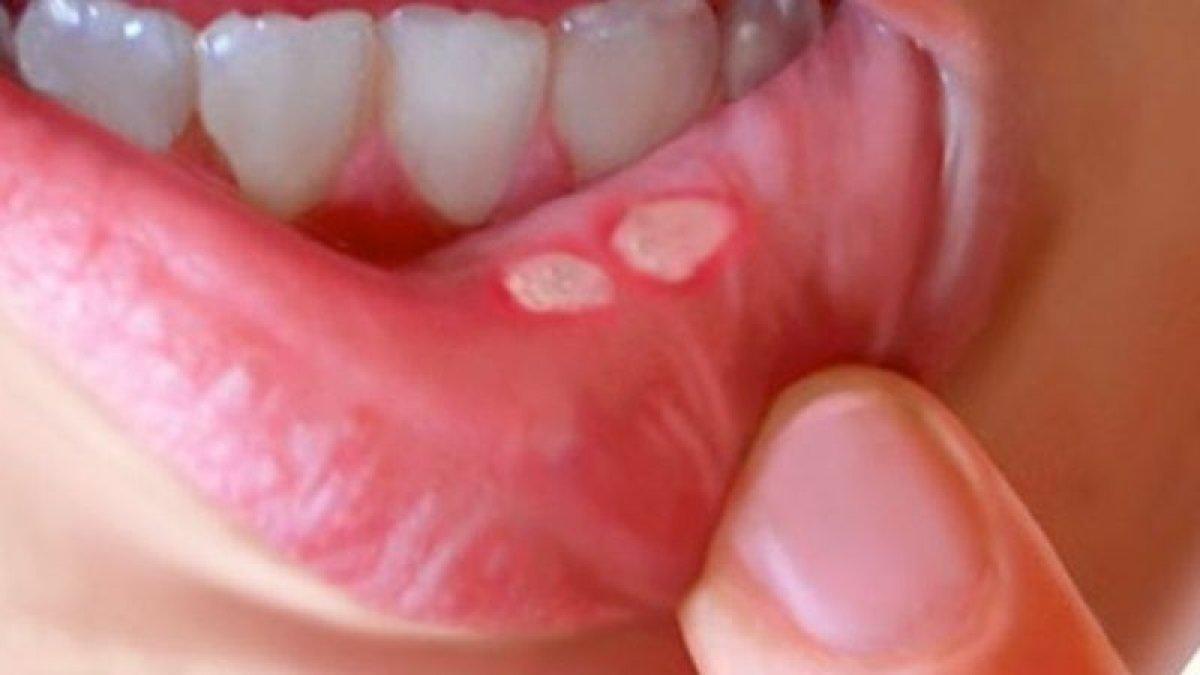 Ağız kuruluğu diyabet belirtisi olabilir