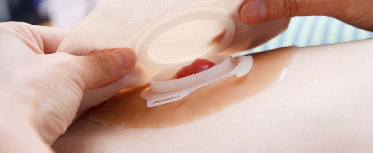 Stoma nedir