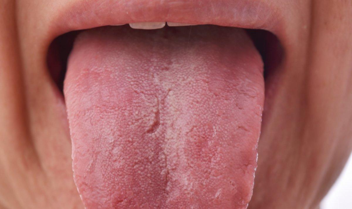 Ağız kuruluğu diyabet belirtisi olabilir