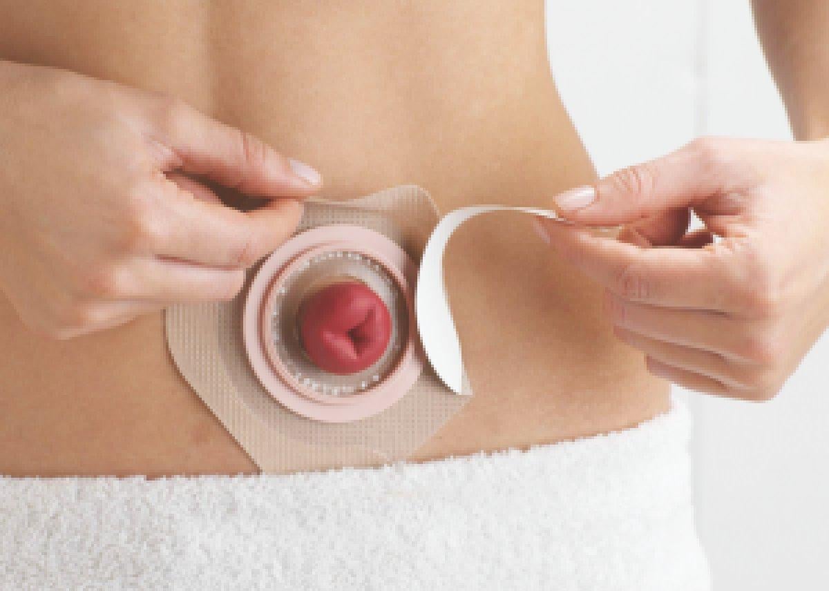 Stoma nedir