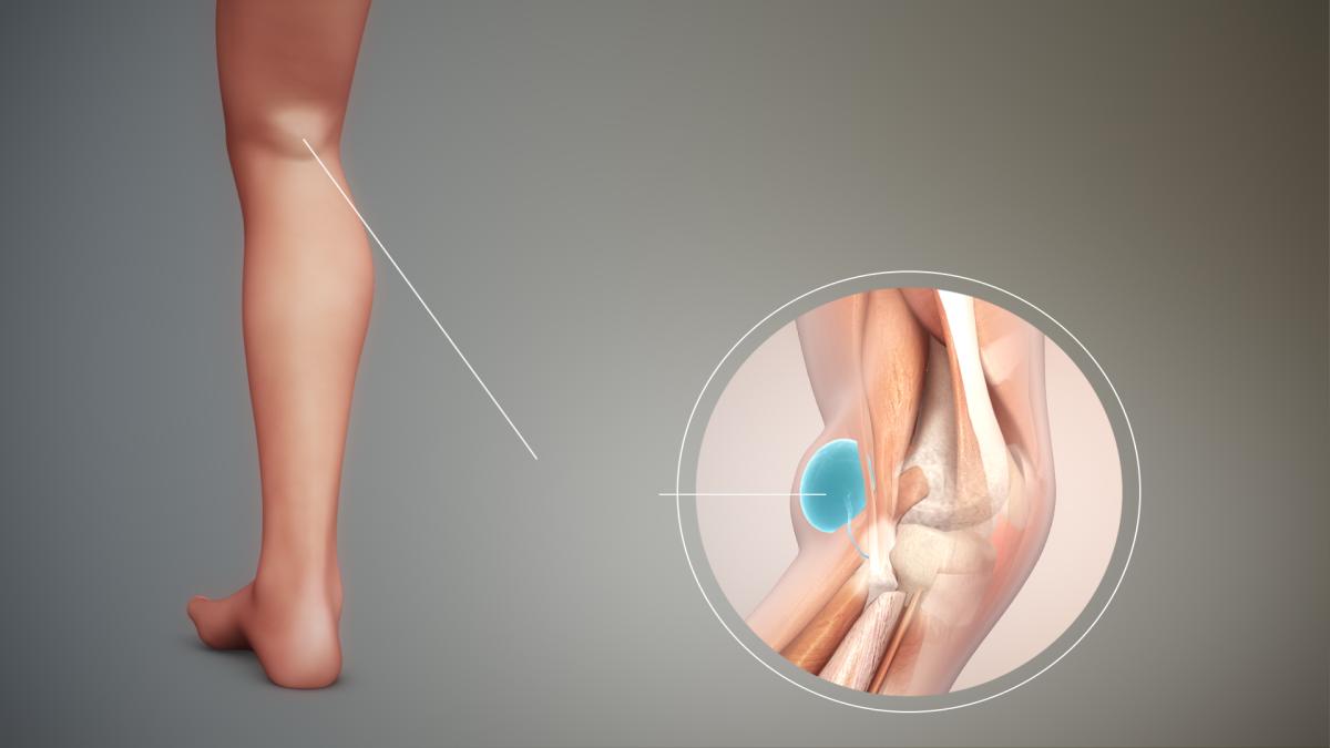 Diz ağrılarının en yaygın 4 nedeni