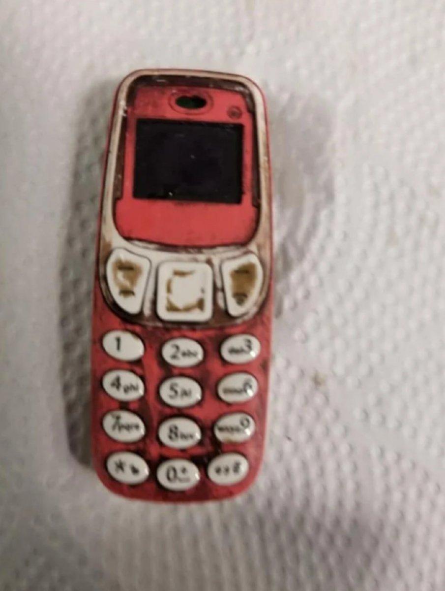 Kosova'da midesinden Nokia 3310 çıktı