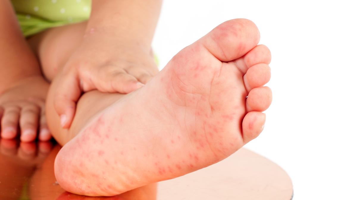 Aileleri korkutan bulaşıcı hastalık: EAAH