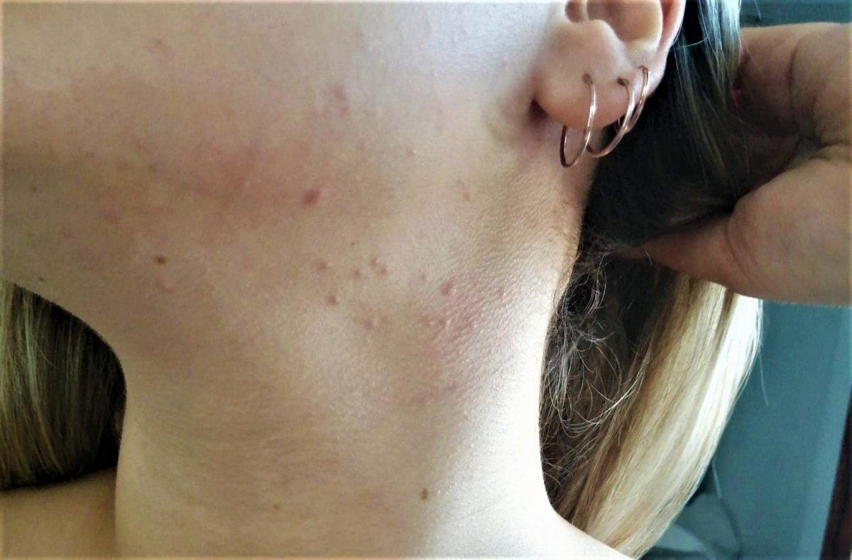 Kaşıntı ve kabarıklığa neden olan ter alerjisine karşı uyarı yapıldı