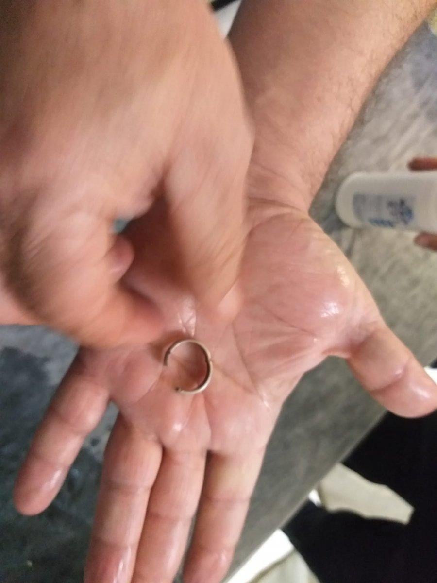 Siirt’te, genç kızın parmağında sıkışan yüzük 1 saatte çıkarıldı