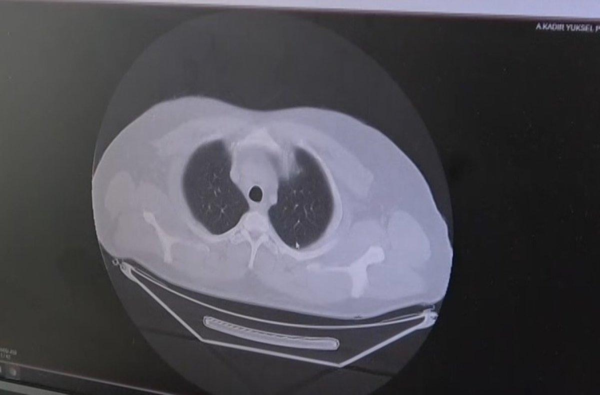 Gaziantep'te aşı randevusu yerine taziyeye gidince koronayı kaptı