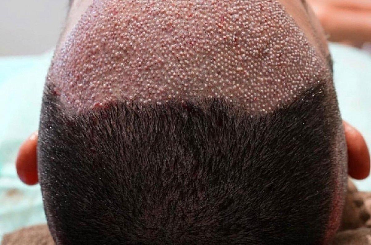 Saç ekimi yaptırmanın riskleri