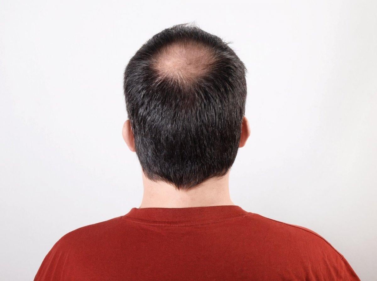 Saç ekimi yaptırmanın riskleri