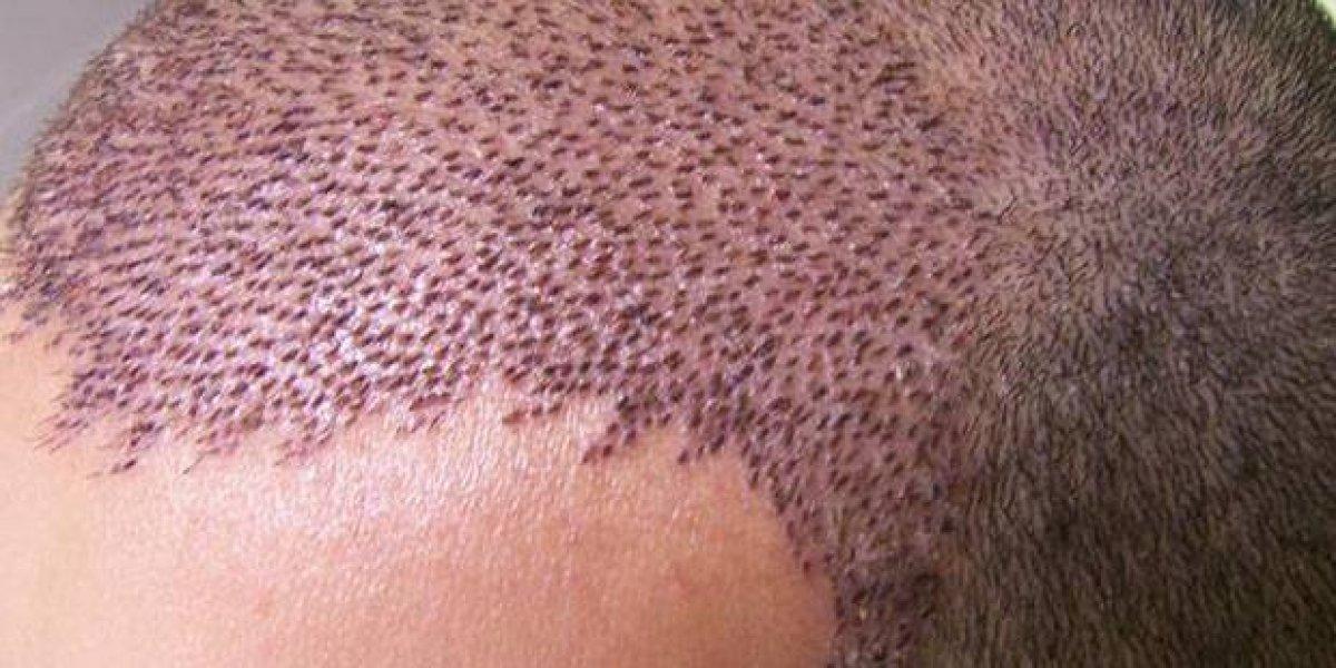 Saç ekimi yaptırmanın riskleri