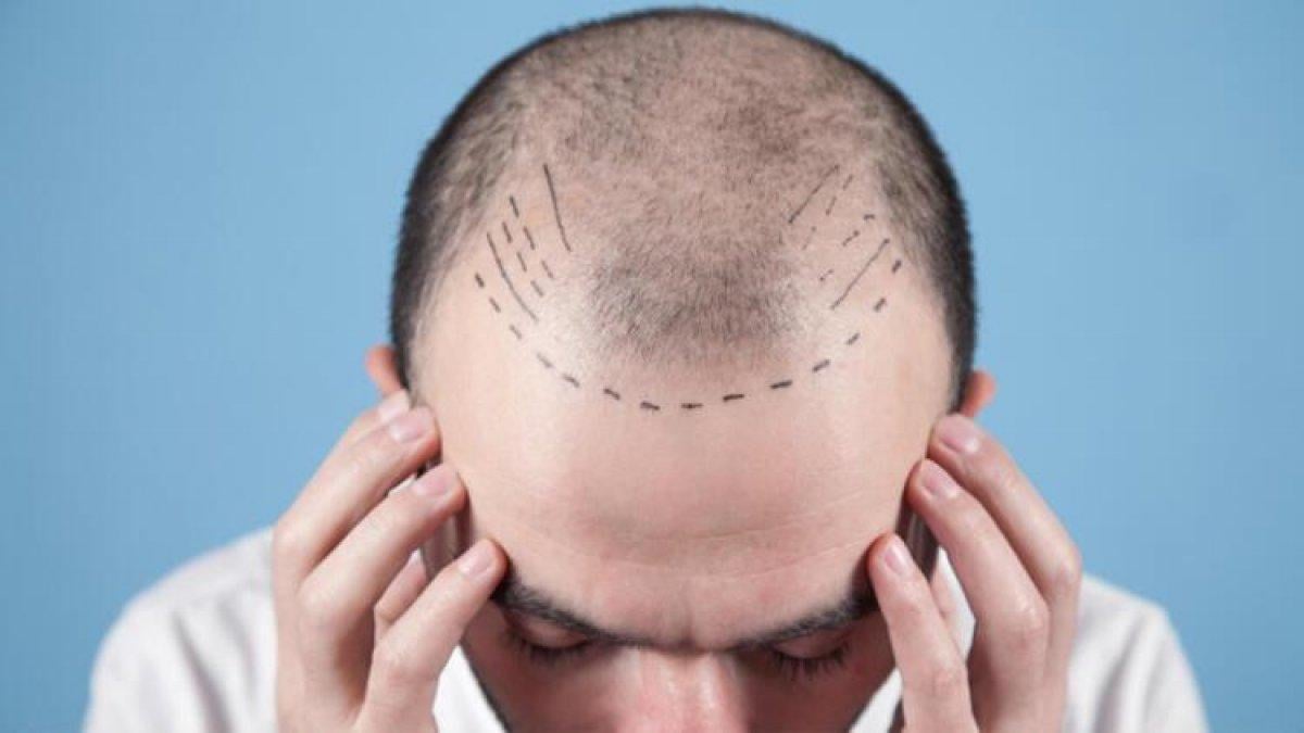 Saç ekimi yaptırmanın riskleri