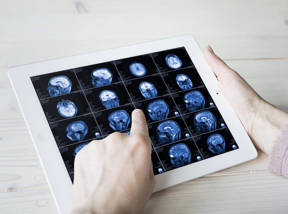 Beyin kanaması belirtileri ve önlemek için ipuçları