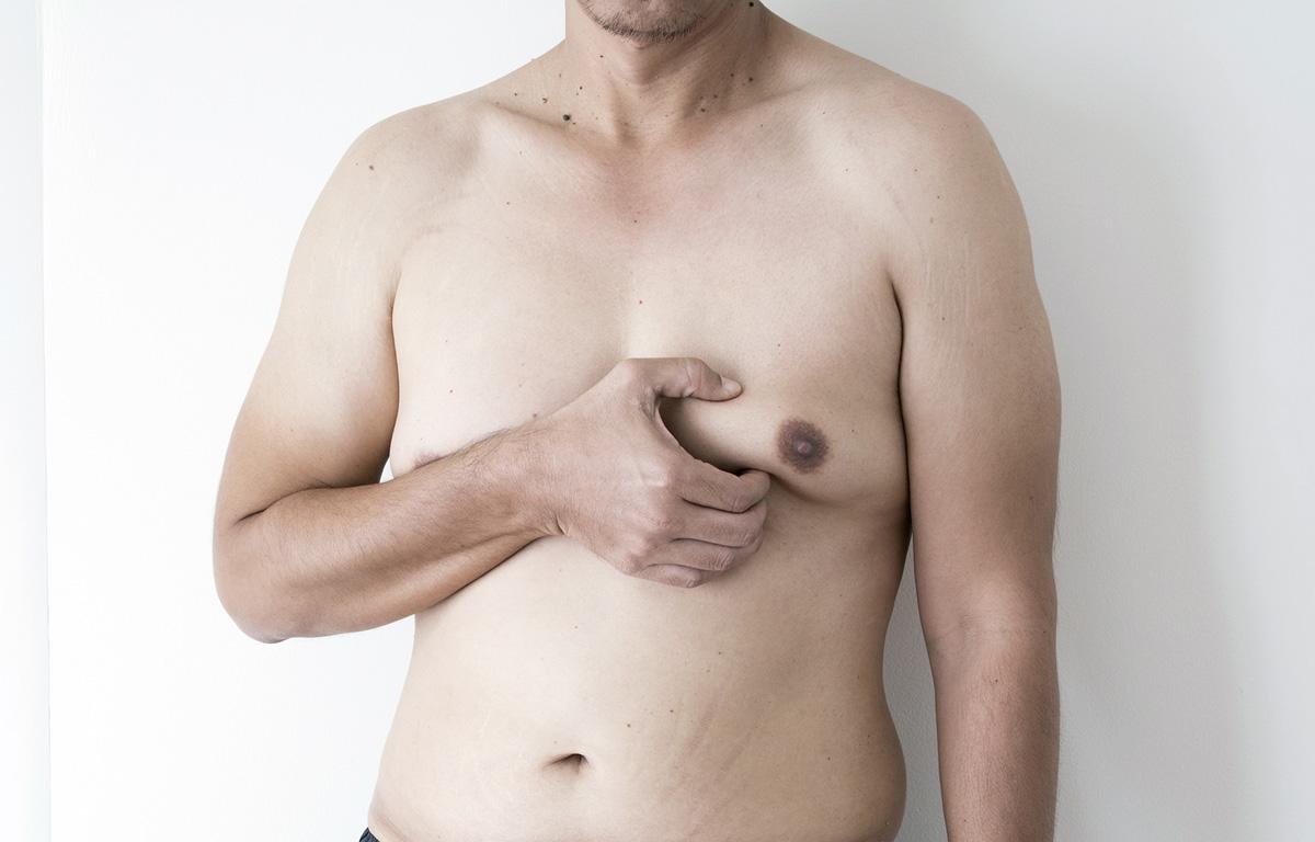 Erkeklerin yüzde 50’sinde jinekomasti görülüyor