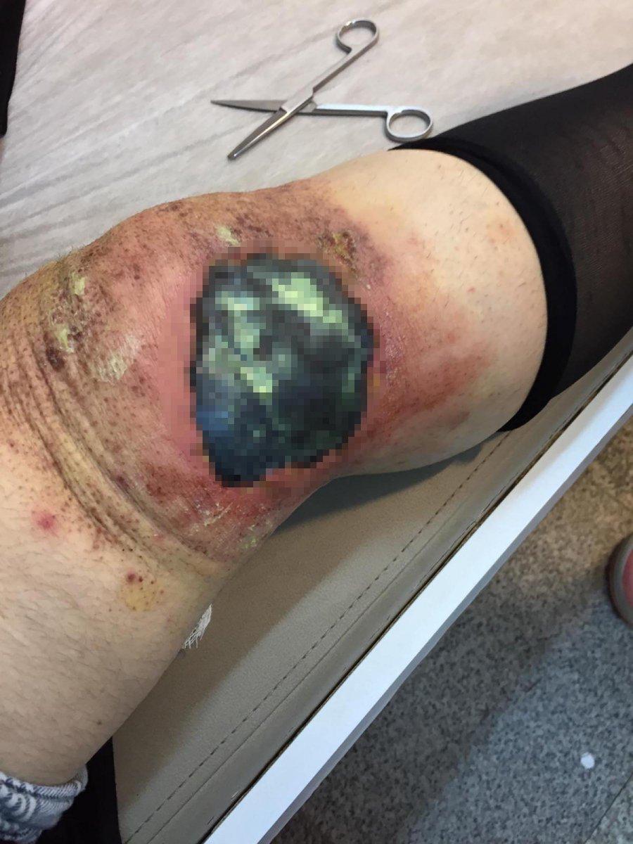 Ağrı’da kulaktan dolma tedaviyi uygulayan kadının dizi yandı