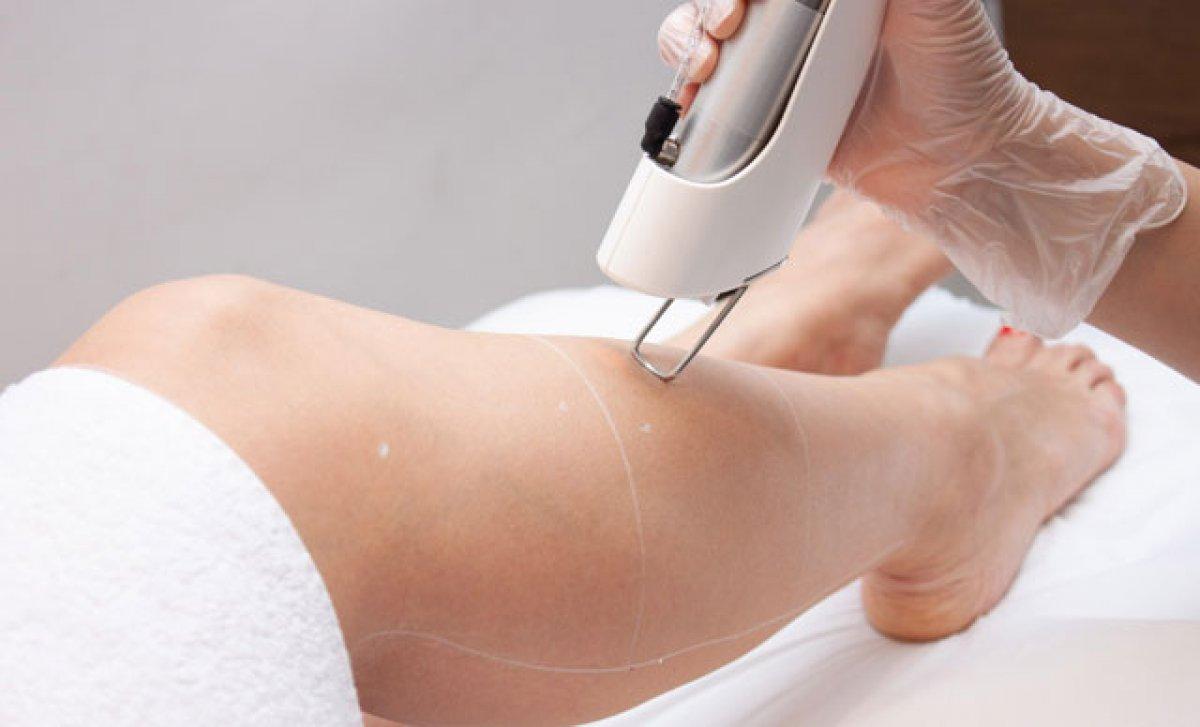 Lazer epilasyon yasaklandı mı? Danıştay'dan güzellik merkezlerine kötü haber