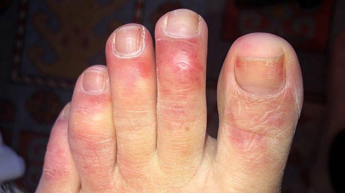 Morarmalara dikkat: Covid parmağı sendromu belirtileri