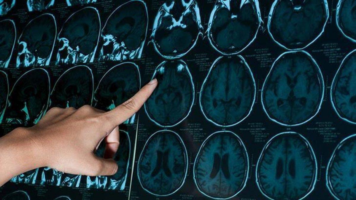 MIND diyeti: Beyni besleyen ve beslemeyen yiyecekler