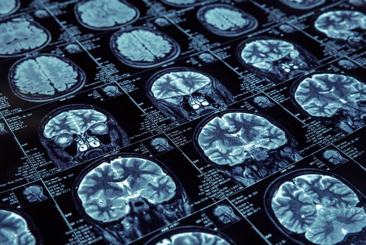 MIND diyeti: Beyni besleyen ve beslemeyen yiyecekler