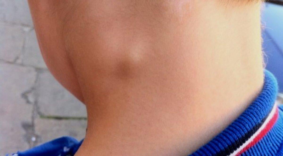 Lenf bezi şişmesi nasıl anlaşılır