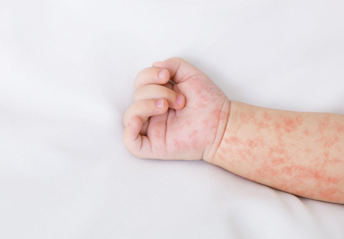 Dünyanın en ölümcül 10 viral hastalığı