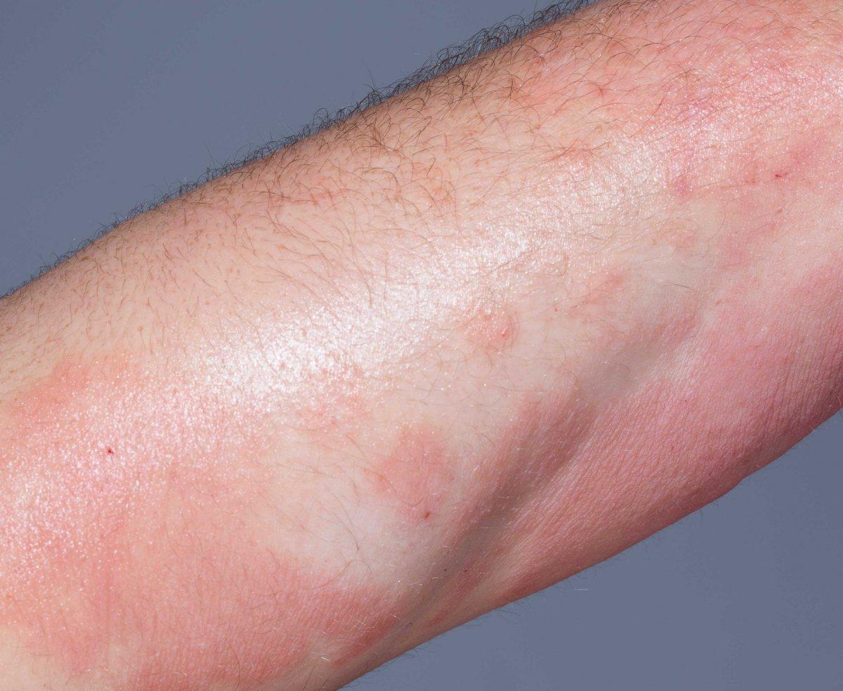 Sedef hastalığı belirtileri ve tedavi yöntemleri