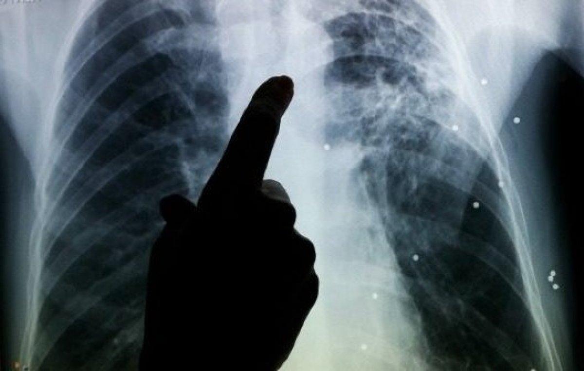 DSÖ: Koronavirüsle mücadele edilirken verem vakaları arttı