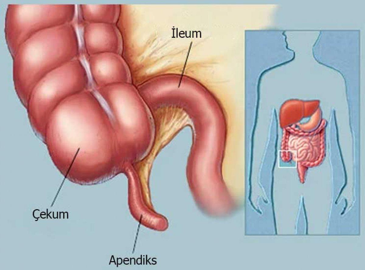 Apandisit için ayırt edici belirtiler ve yapılması gerekenler