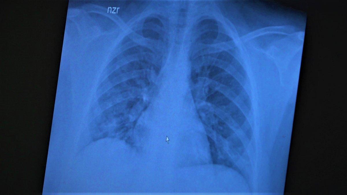 Koronaya yakalanan 15 yaş altı çocuklarda ciddi akciğer tutulumları görüldü