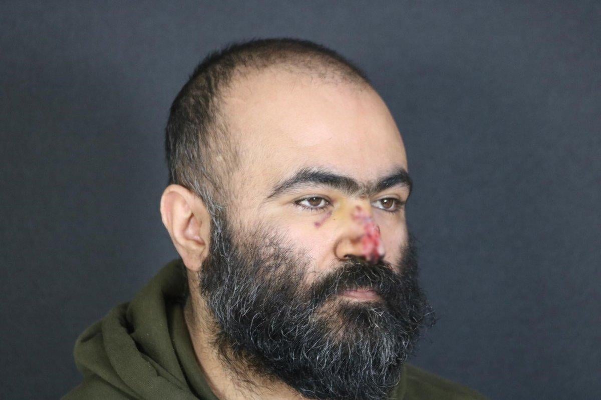 Samsun’da, pitbull saldırısında kopan burnuna yama yapıldı