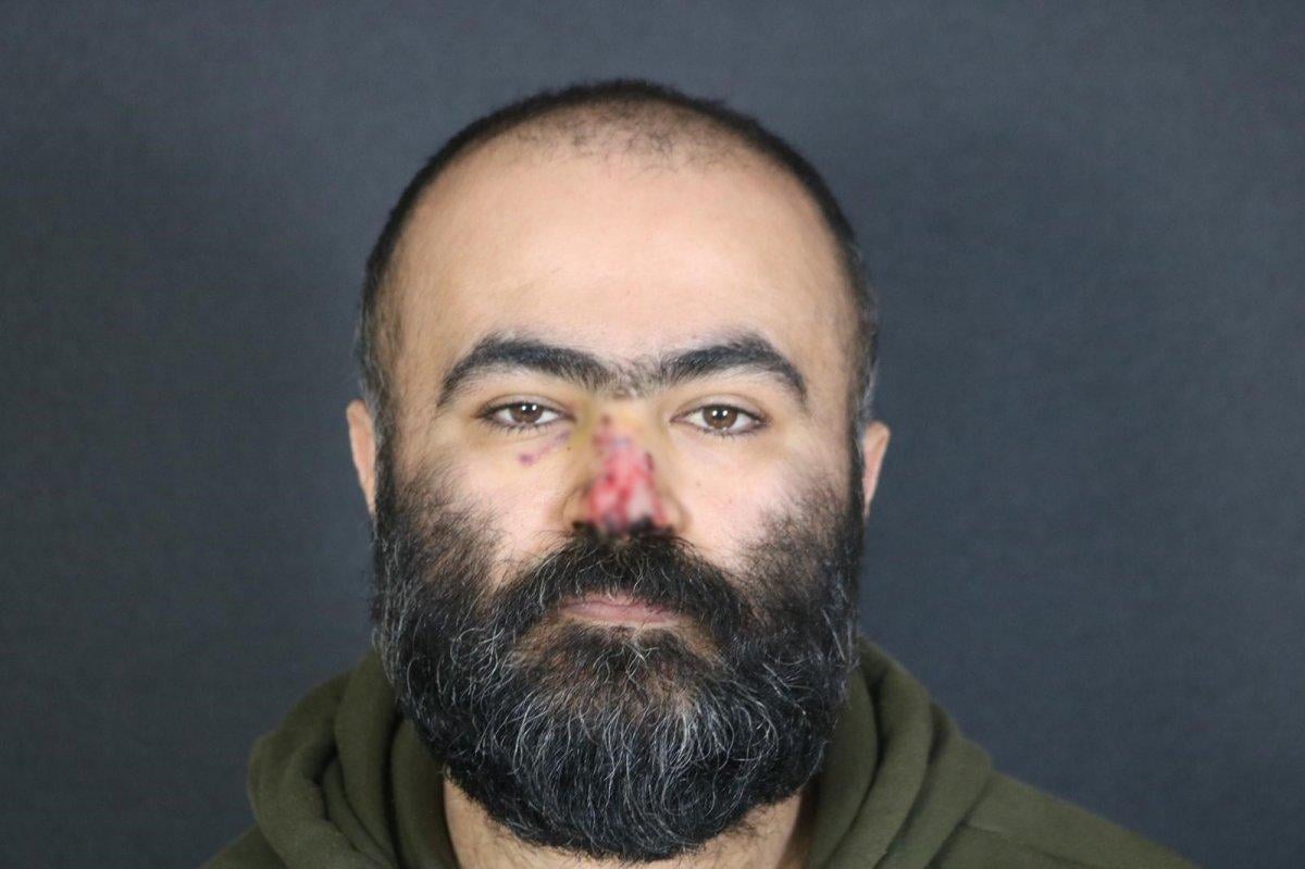 Samsun’da, pitbull saldırısında kopan burnuna yama yapıldı