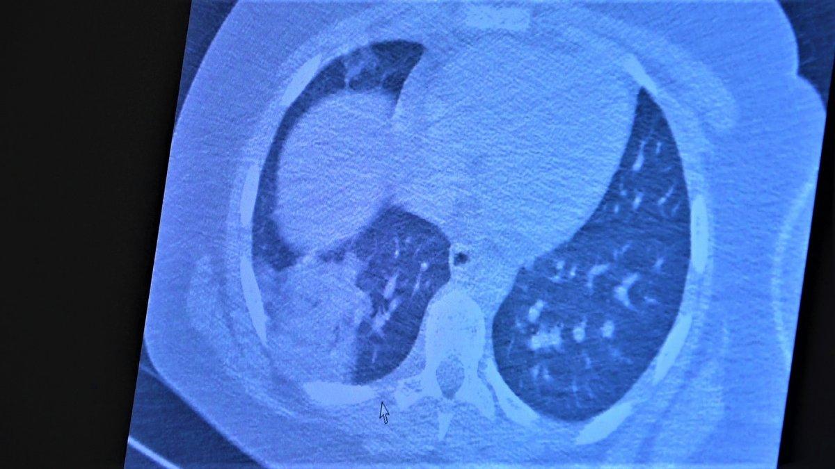 Koronaya yakalanan 15 yaş altı çocuklarda ciddi akciğer tutulumları görüldü