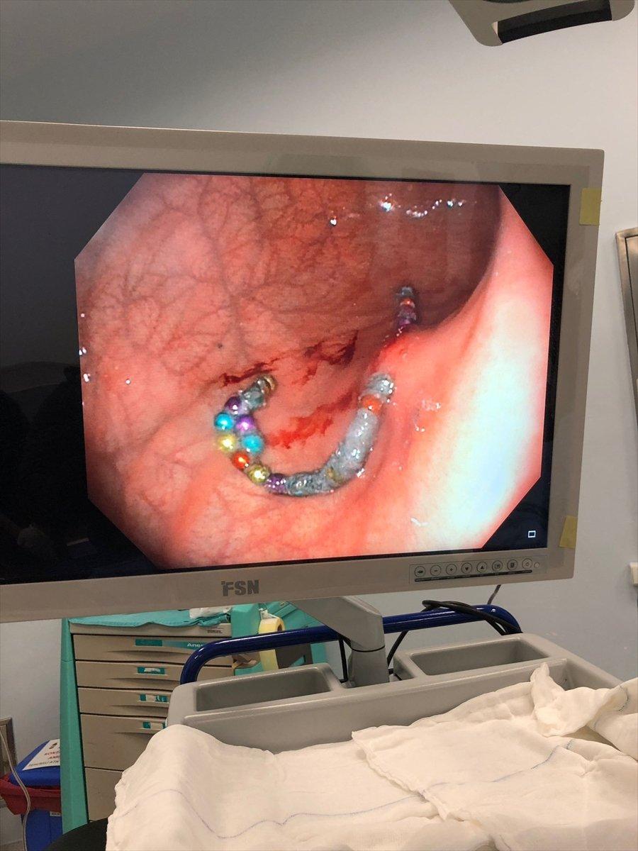 Denizli'de 19 aylık Murat'ın midesinden boncuk mıknatıslar çıkarıldı