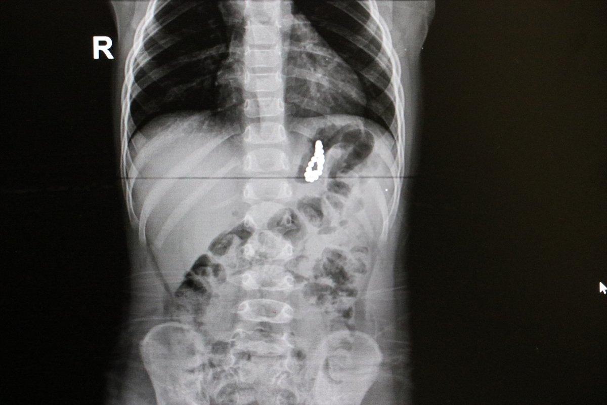 Denizli'de 19 aylık Murat'ın midesinden boncuk mıknatıslar çıkarıldı