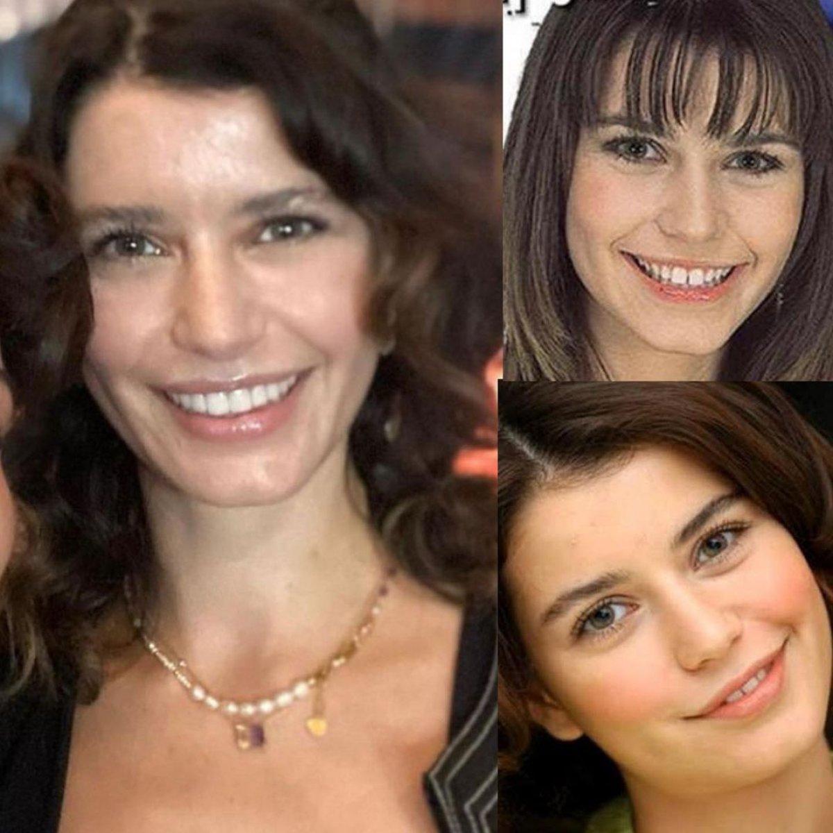 Beren Saat, dişlerini yaptırdı