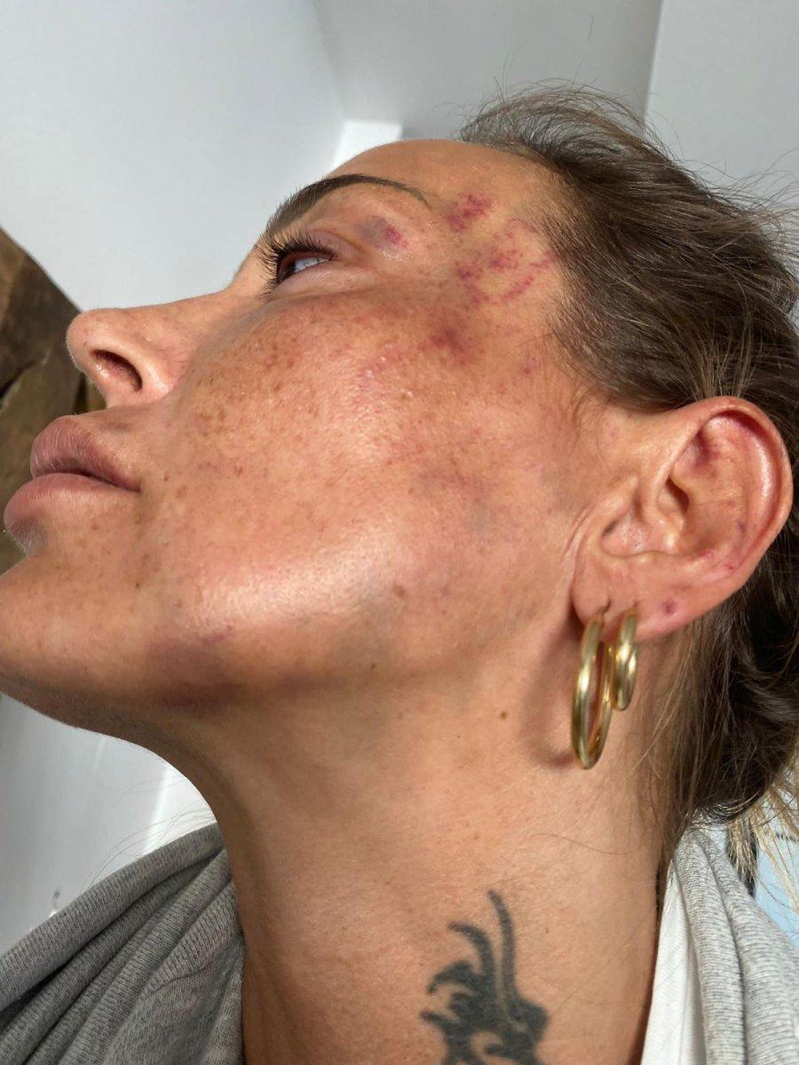 Bursa'da eski sevgiliye dayağa 12 yıl hapis istemi