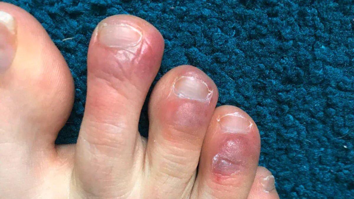 Koronavirüs sonrası görülebilen 11 semptom