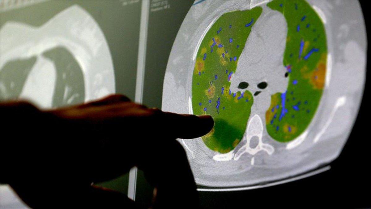 Koronavirüs beyin hücrelerine hasar veriyor mu araştırması
