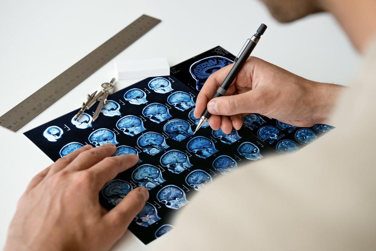 Beyin tümörü riskini artıran 5 faktör