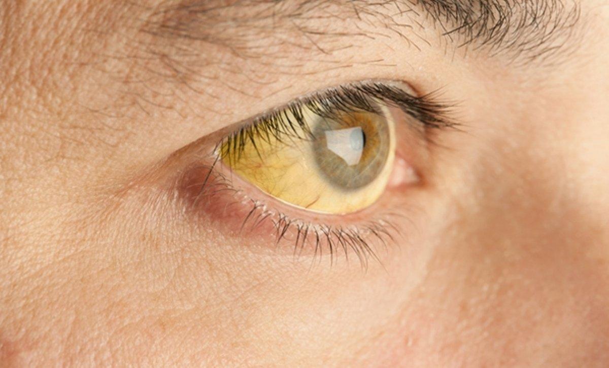 Karaciğer yağlanmasının 6 sinsi belirtisi