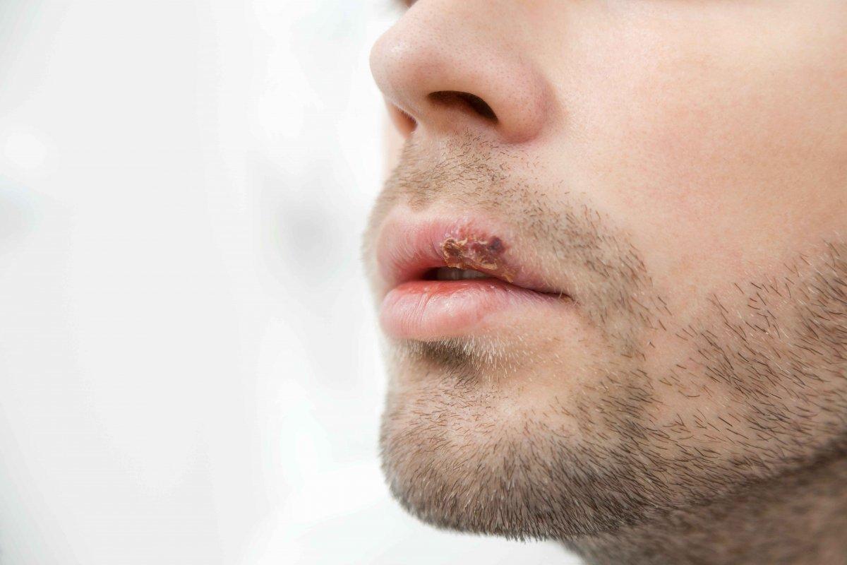 Dudakta uçuk neden çıkar ve nasıl geçer